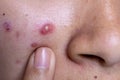 Backgrounds of lesions skin caused by acne on the face.