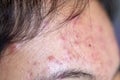 Lesions skin caused by acne on the face in the clinic.