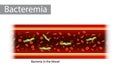 Bacteremia is the presence of bacteria in the blood. Royalty Free Stock Photo