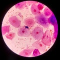 Bacteria cell Gram neagative bacilli with capsule.Sample sputum in Gram stain method Royalty Free Stock Photo