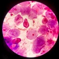 Bacteria cell Gram neagative bacilli with capsule.Sample sputum in Gram stain method Royalty Free Stock Photo