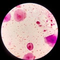 Bacteria cell Gram neagative bacilli with capsule.Sample sputum in Gram stain method