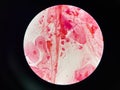 Bacteria cell in sputum sample Gram stain method