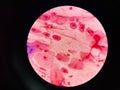 Bacteria cell in sputum sample Gram stain method