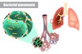 Bacteria inside alveoli of lung. Bacterial pneumonia bacterial infection. Royalty Free Stock Photo