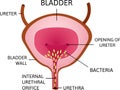 Bacteria in urinary bladder or simply bladder. Green small cell which causes inflammation.