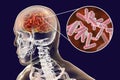 Bacterial brain infection medical concept, meningitis, encephalitis Royalty Free Stock Photo