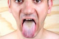 Bacterial infection disease tongue and herpes