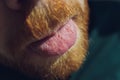 Bacterial infection disease tongue in a man.