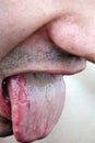 Bacterial infection disease tongue