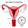 Bacterial vaginosis. Cross section of Human uterus. Close-up of G. vaginalis. Royalty Free Stock Photo