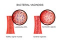 Bacterial vaginosis. the vagina and the causative agent Royalty Free Stock Photo