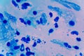 The bacterium Mycobacterium tuberculosis undermicroscope 100x /AFB POSITIVE showing Royalty Free Stock Photo