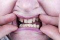 Bad defective teeth