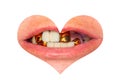 Bad smile with teeth and metal dental crowns close-up in the shape of a heart. Concept isolate on white background valentine Royalty Free Stock Photo