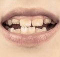 Bad teeth child. Portrait boy with bad teeth. Close up of unhealthy baby teeths. Kid patient open mouth showing cavities