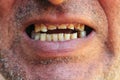 Bad teeth, close up. Smoker with bad teeth Royalty Free Stock Photo