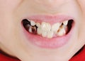 Bad teeth, closeup Royalty Free Stock Photo