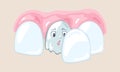 Bad tooth is among healthy teeth. Installation of veneer, implant, whitening procedure.
