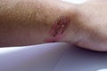 Badly healed burn on Caucasian young man`s wrist