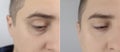 Before and after. Bags under eyes, hernias on the man face. Patient being examined by a plastic surgeon. Before and after