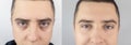 Before and after. Bags under eyes, hernias on the man face. Patient being examined by a plastic surgeon. Before and after