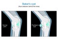 Baker`s cyst. knee joint Royalty Free Stock Photo