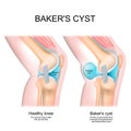 Baker`s cyst. Normal knee, and joint with Popliteal cyst