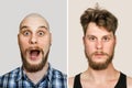 Bald guy before after haircut Concept for a barber shop: the problem man of hair loss, alopecia, transplantation Royalty Free Stock Photo