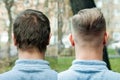 Bald guy before after haircut Concept for a barber shop: the problem man of hair loss, alopecia, transplantation, back Royalty Free Stock Photo