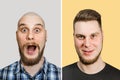 Bald guy before after haircut Concept for a barber shop: the problem man of hair loss, alopecia, transplantation Royalty Free Stock Photo