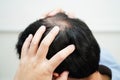 Bald head in man, hair loss treatment health problem Royalty Free Stock Photo