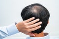 Bald in the middle head and begin no loss hair glabrous of mature Asian business smart active office man Royalty Free Stock Photo