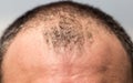 Bald spots on the head of a man Royalty Free Stock Photo