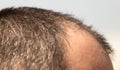 Bald spots on the head of a man Royalty Free Stock Photo