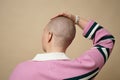 Bald young woman touching head Royalty Free Stock Photo