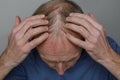 Balding man, rear view, close-up of top of head Royalty Free Stock Photo