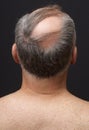 Balding Man's Head