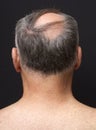 Balding Man's Head Portrait