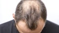 Balding young man, Hair loss problem Royalty Free Stock Photo