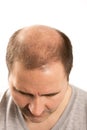 Baldness Alopecia man hair loss haircare Royalty Free Stock Photo