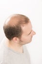 Baldness Alopecia man hair loss haircare Royalty Free Stock Photo