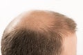 Baldness Alopecia man hair loss haircare Royalty Free Stock Photo