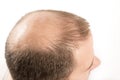 Baldness Alopecia man hair loss haircare Royalty Free Stock Photo