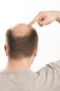 Baldness Alopecia man hair loss haircare Royalty Free Stock Photo