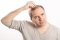 Baldness Alopecia man hair loss haircare Royalty Free Stock Photo
