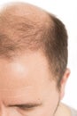 Baldness Alopecia man hair loss haircare Royalty Free Stock Photo