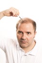 Baldness Alopecia man hair loss haircare Royalty Free Stock Photo