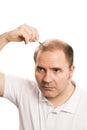 Baldness Alopecia man hair loss isolated Royalty Free Stock Photo