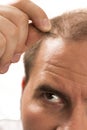 Baldness Alopecia man hair loss isolated Royalty Free Stock Photo